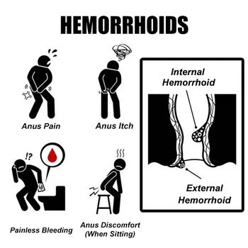 2Boxes UUS Hemorroidid Salvi Taimede, Taimsete Materjalide Võimas Hemorroidid Koor Sisemiste Hemorroidide Välise Anal Terviku Box